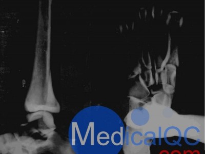 美国RSD RS-116脚模体图2