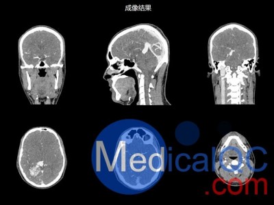 NLP1000头颈模体，NLP1000头部模体图2