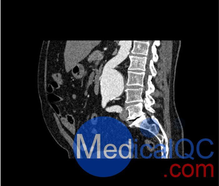 WEK53-05腹部模体，WEK53-05动脉瘤腹部模体，WEK53-05 CT血管造影模型